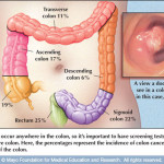 Colorectal_cancer_lg
